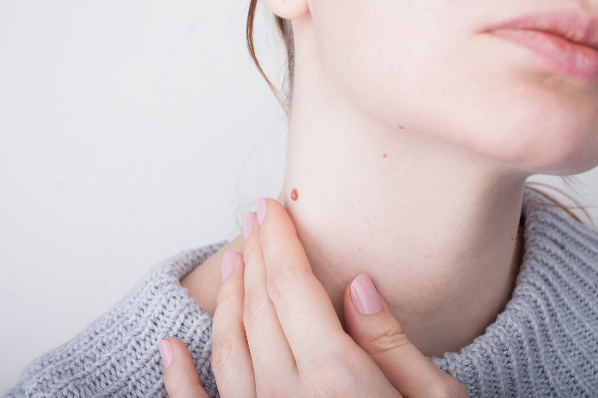 Girl with birthmarks on the neck