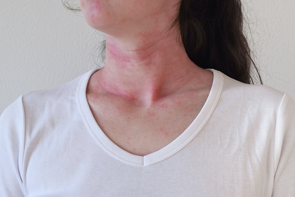 Woman Breaking Out In Hives From An Allergic Reaction Hand Sanitizer Germs