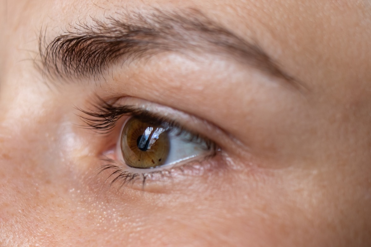 Macro eye photo. Keratoconus - eye disease, thinning of the cornea in the form of a cone. The cornea plastic.