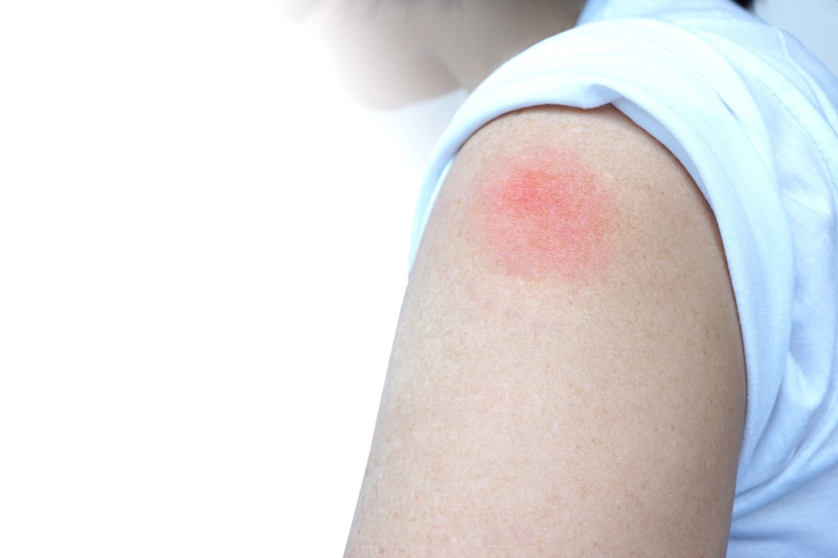 person wearing white t shirt with red spot on arm where a vaccine has been given