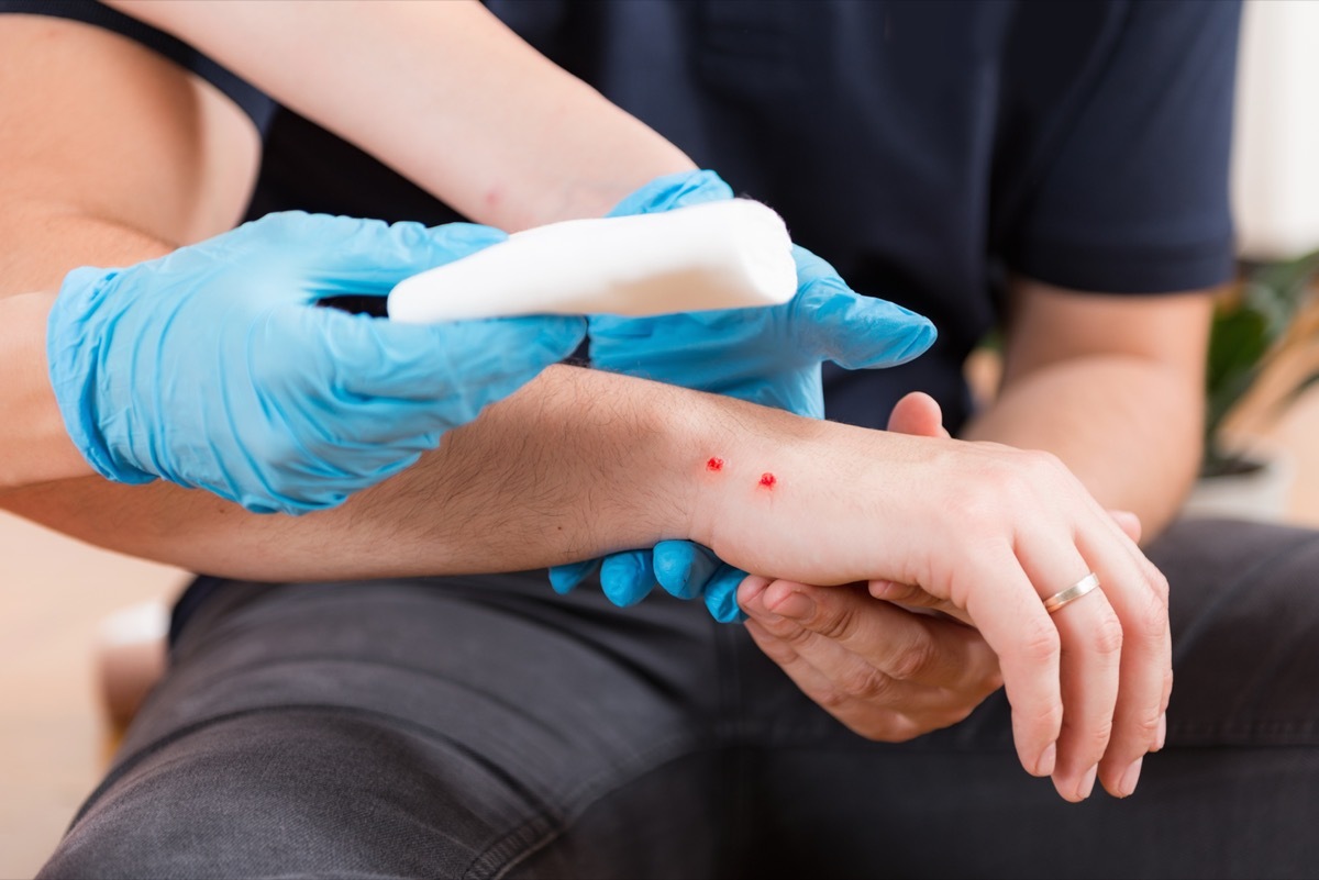 Snake Bite Wound Being Cleaned