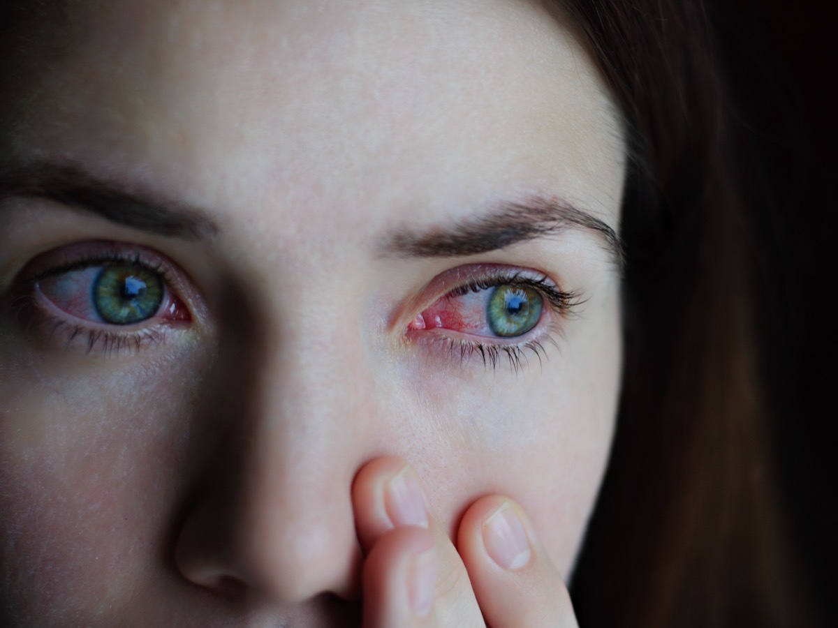 woman with red bloodshot eyes