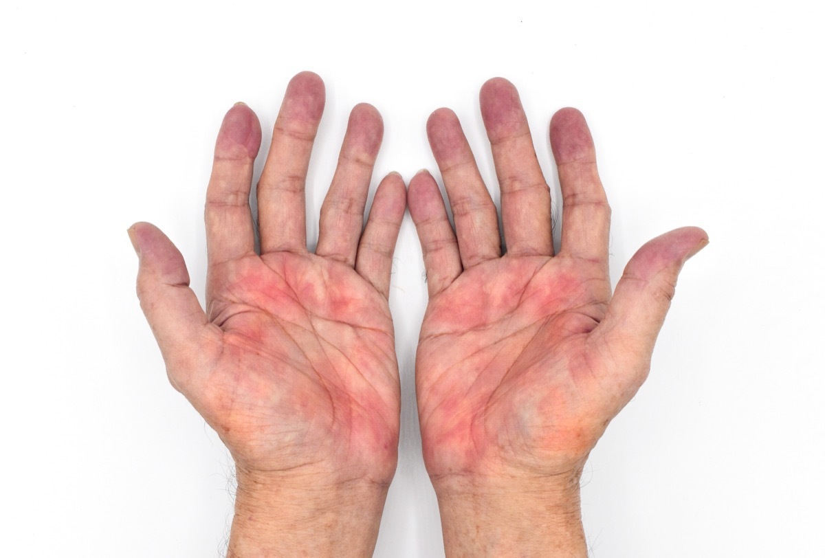 palmar erythema