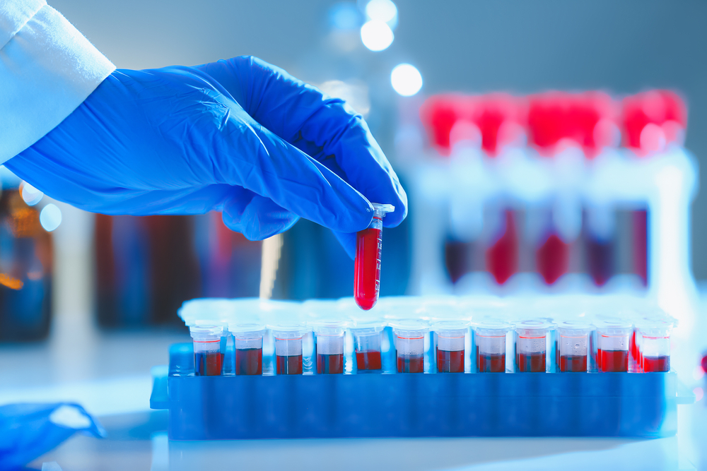 A closeup of a doctor's hand reaching for a blood sample in a vial