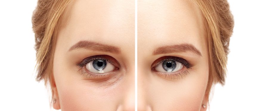 Lower Eyelid Surgery | Blepharoplasty – Eyelid Surgery For A Fresher, Younger Look | Her Beauty