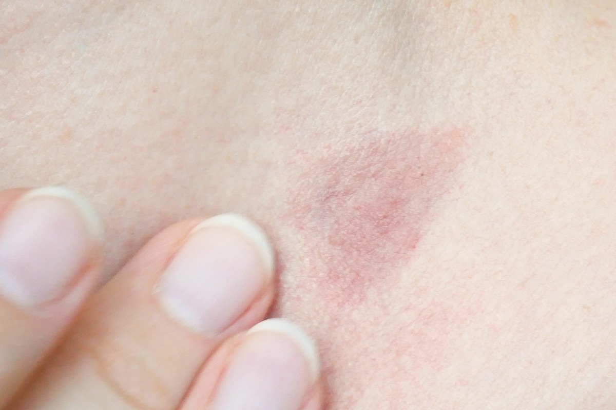 skin rash treatment on woman neck